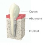 dental-implant graphic