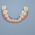 A computer generated image of Chessa's teeth before Invisalign.  As you can see, the image is an exact replication of the current alignment of her teeth. 