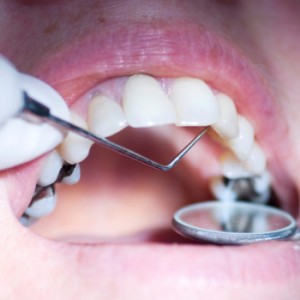 dental-fillings-350x350