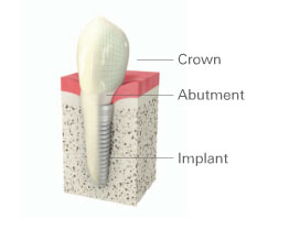 dental-implant graphic