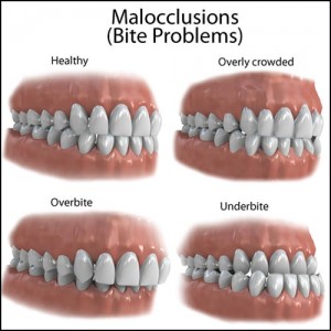 bite-problems-malocclusions_large