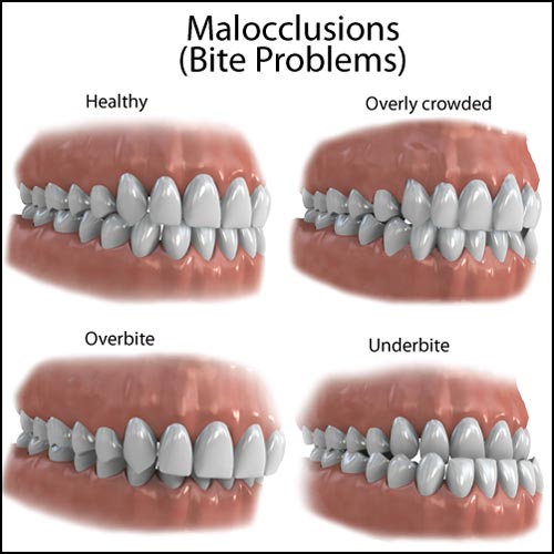 crowded teeth gum disease