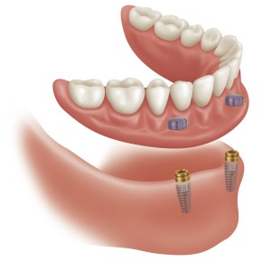 supported-dentures1