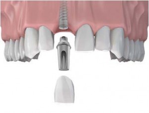 dental-implant graphic 2