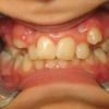 Amazing Transformation with Invisalign!