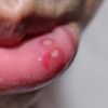 Help for Canker Sores