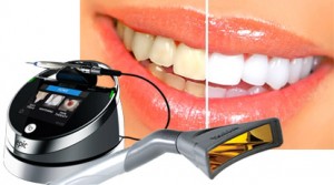 laser-teeth-whitening